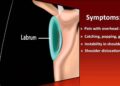 shoulder labrum tear test treatments
