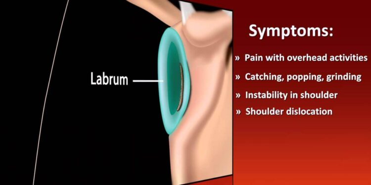 shoulder labrum tear test treatments