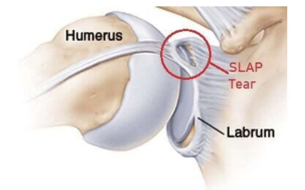 shoulder labrum tear