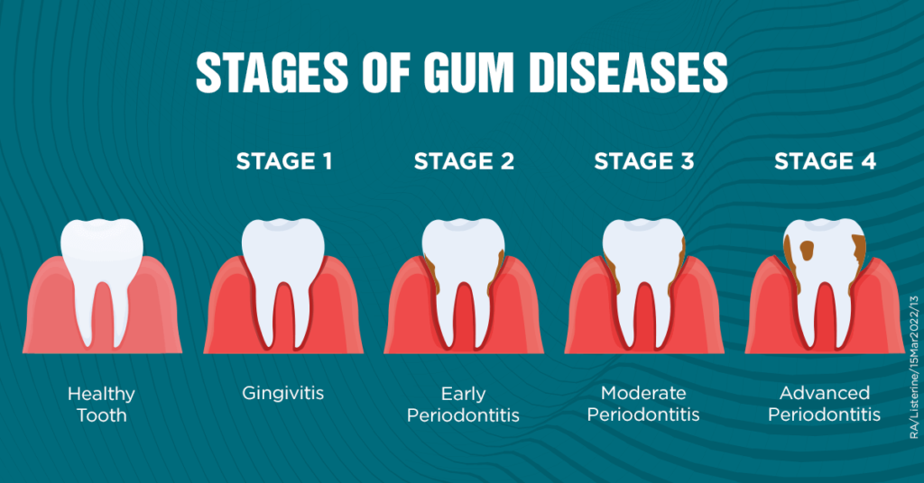 stages of periodontitis