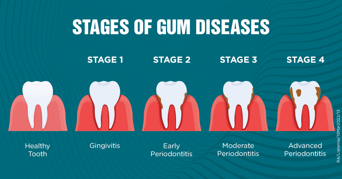 The Causes and Risk Factors of Periodontitis - Now Then Digital