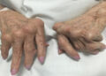 what are the 4 stages of rheumatoid arthritis