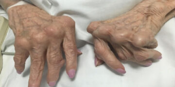 what are the 4 stages of rheumatoid arthritis