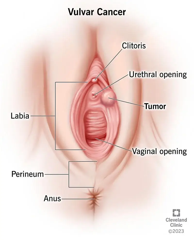 early vulvar cancer pictures
